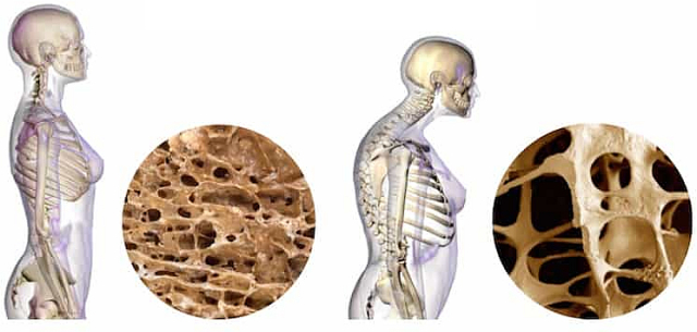 Osteoporóza: Tichý zlodej kostí